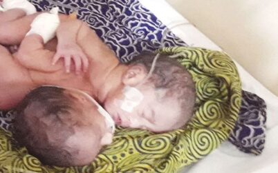 বিরল ঘটনা: পেটে জোড়া লাগা যমজ শিশুর জন্ম